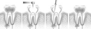 Wurzelspitzenresektion beim Zahnarzt